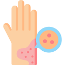 علاج الصدفية علاج الصدفية